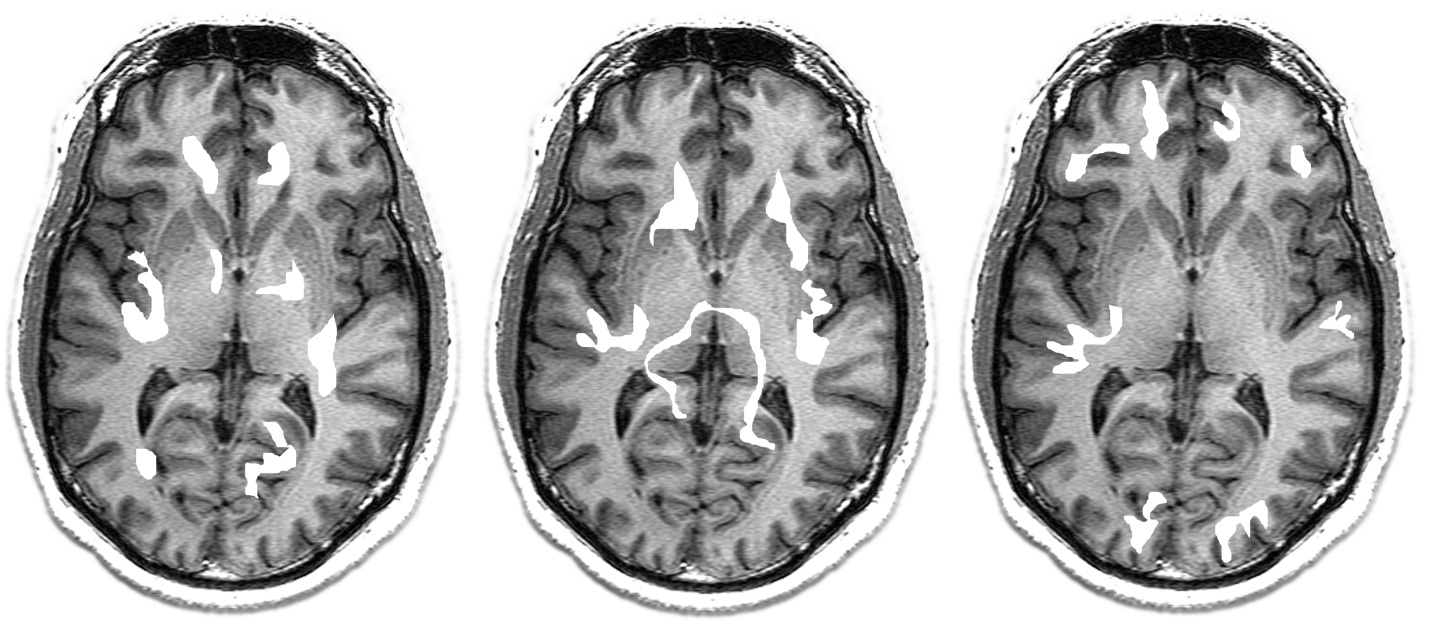 fMRI brain scans — three axial MRI slices with activation regions highlighted, showing different patterns of neural activity